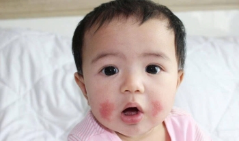 Bé ăn dặm bị dị ứng thực phẩm: Dấu hiệu nhận biết và cách xử lý