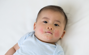 Rôm Sảy Ở Trẻ Nhỏ – Mẹ Bôi Kem Rau Má Có Hiệu Quả Không?